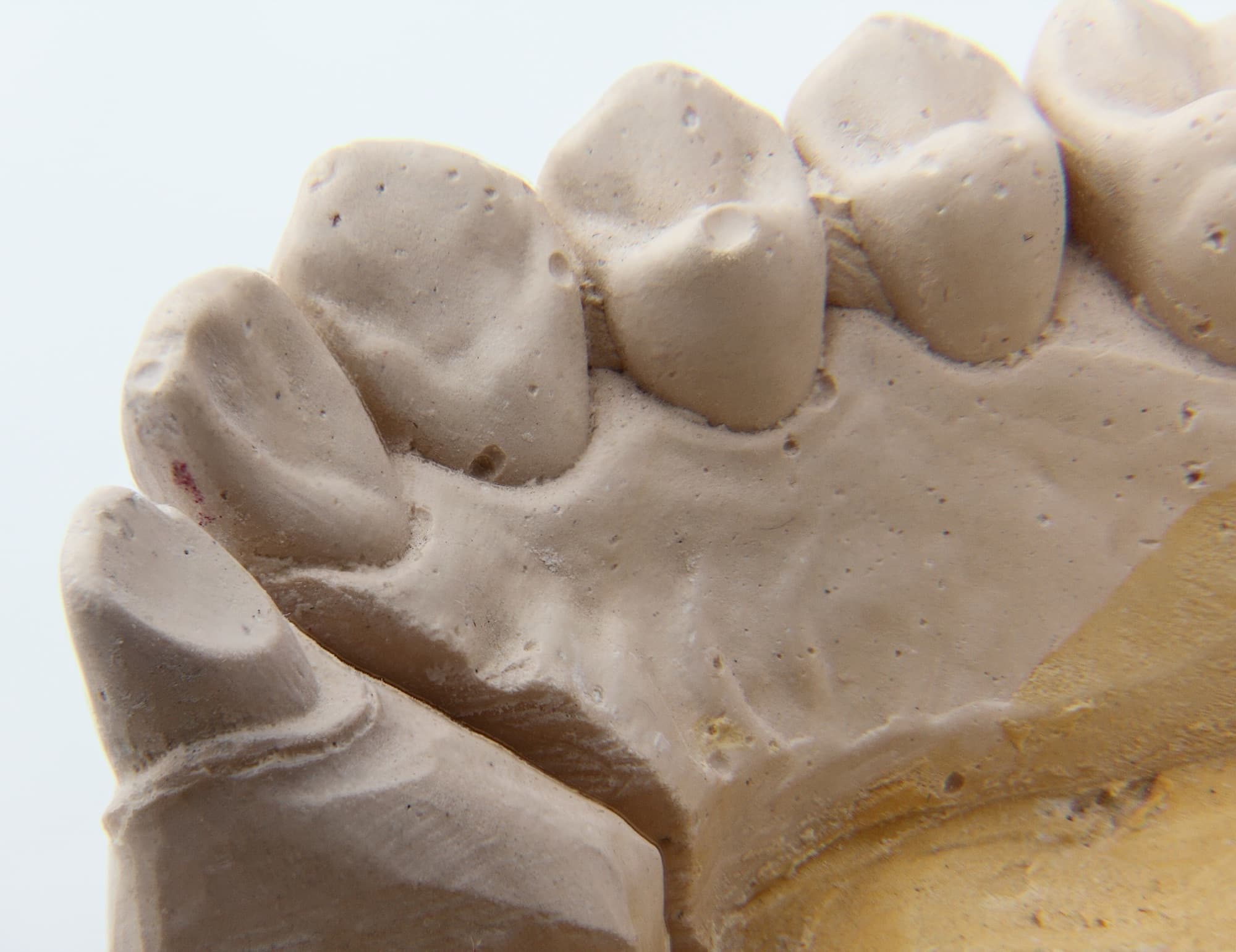 A dental crown photographed at the margin, showing the fit line where the restoration meets the preparation.